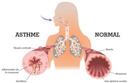 Asthme ancien